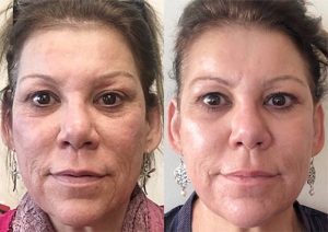 Scarlet SRF Before & After - full face